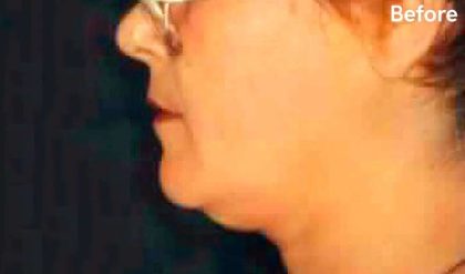 Chin Liposuction Before & After Patient #2495