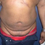 Daddy Makeover Before & After Patient #2527