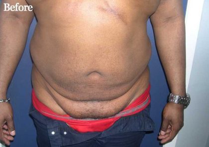 Daddy Makeover Before & After Patient #2527