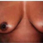 Mommy Makeover Before & After Patient #2944