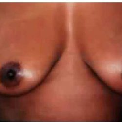Mommy Makeover Before & After Patient #2944