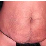 Mommy Makeover Before & After Patient #2944