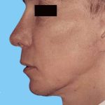 Facelift Male Before & After Patient #2677