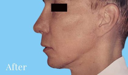 Facelift Male Before & After Patient #2677