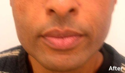 Fat Transfer Male Before & After Patient #2698
