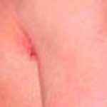 Gynecomastia Before & After Patient #2725
