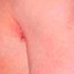 Gynecomastia Before & After Patient #2725