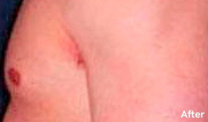 Gynecomastia Before & After Patient #2725