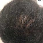 Hair Restoration Before & After Patient #2805