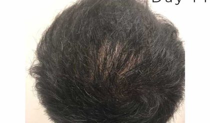 Hair Restoration Before & After Patient #2805