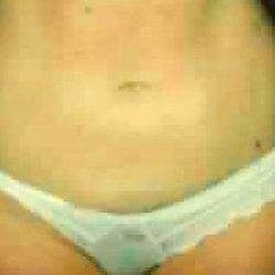 Liposuction Before & After Patient #2888