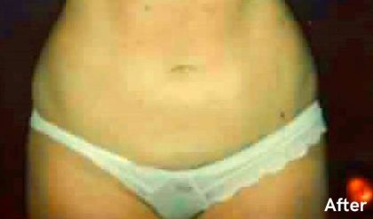 Liposuction Before & After Patient #2888