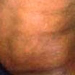 Liposuction Male Before & After Patient #2921