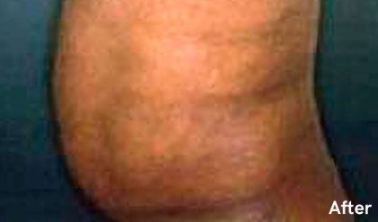 Liposuction Male Before & After Patient #2921