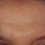 Botox Before & After Patient #2163