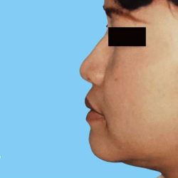 Rhinoplasty Before & After Patient #3006