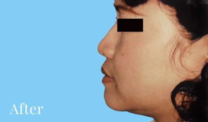 Rhinoplasty Before & After Patient #3006