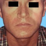 Rhinoplasty Male Before & After Patient #3042