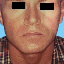 Rhinoplasty Male Before & After Patient #3042