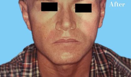 Rhinoplasty Male Before & After Patient #3042