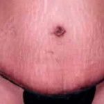 Tummy Tuck Before & After Patient #3081