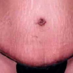 Tummy Tuck Before & After Patient #3081
