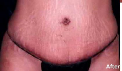 Tummy Tuck Before & After Patient #3081