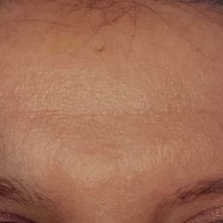 Botox Before & After Patient #2163