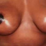 Breast Lift Before & After Patient #2300