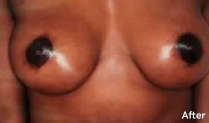 Breast Lift Before & After Patient #2300
