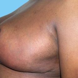 Breast Reduction Before & After Patient #2366
