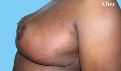 Breast Reduction Before & After Patient #2366