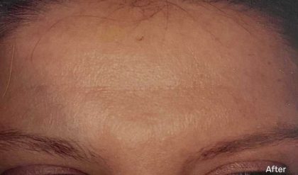 Botox Before & After Patient #2163
