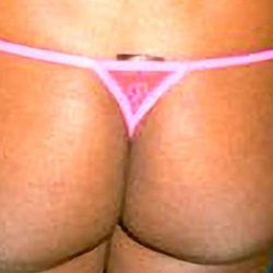 Buttock Augmentation Before & After Patient #2465