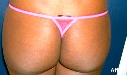 Buttock Augmentation Before & After Patient #2465