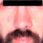 Otoplasty Male Before & After Patient #2553