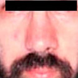 Otoplasty Male Before & After Patient #2553