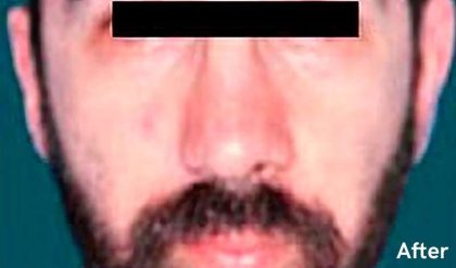 Otoplasty Male Before & After Patient #2553