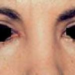 Eyelid Surgery Before & After Patient #2629