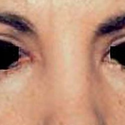 Eyelid Surgery Before & After Patient #2629