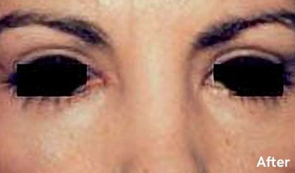 Eyelid Surgery Before & After Patient #2629