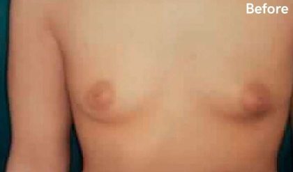 Breast Asymmetry Correction Before & After Patient #2190