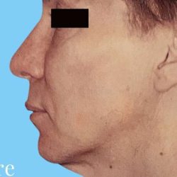 Facelift Male Before & After Patient #2677