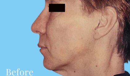 Facelift Male Before & After Patient #2677