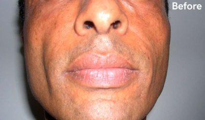 Fat Transfer Male Before & After Patient #2698