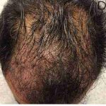 Hair Restoration Before & After Patient #2805