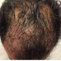 Hair Restoration Before & After Patient #2805