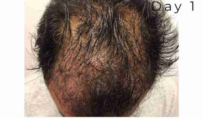 Hair Restoration Before & After Patient #2805