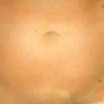 Liposuction Before & After Patient #2888
