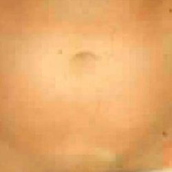 Liposuction Before & After Patient #2888